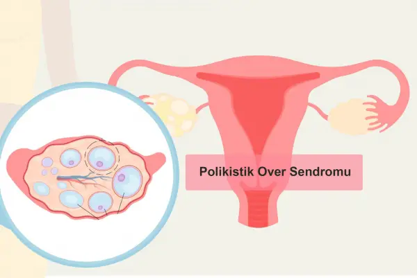 Polikistik Over Sendromu