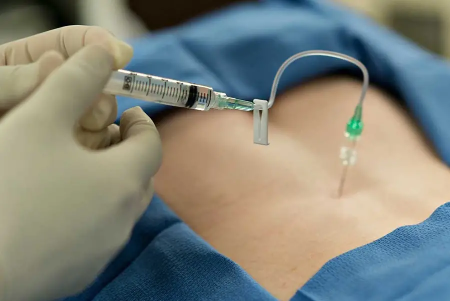 EPİDURAL SEZARYEN
