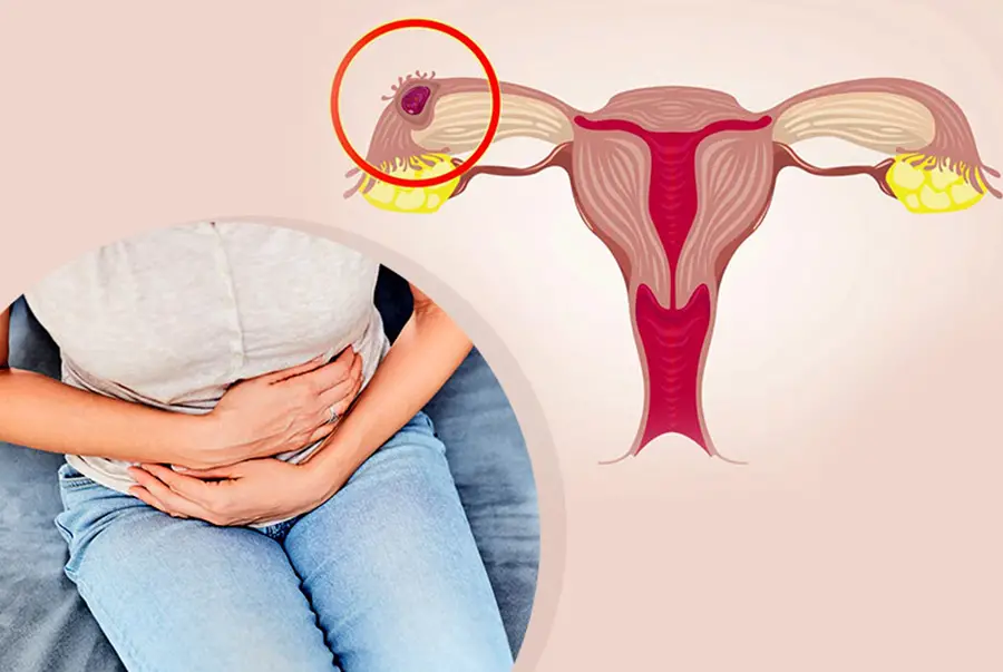 DIŞ GEBELİK OPERASYONLARI