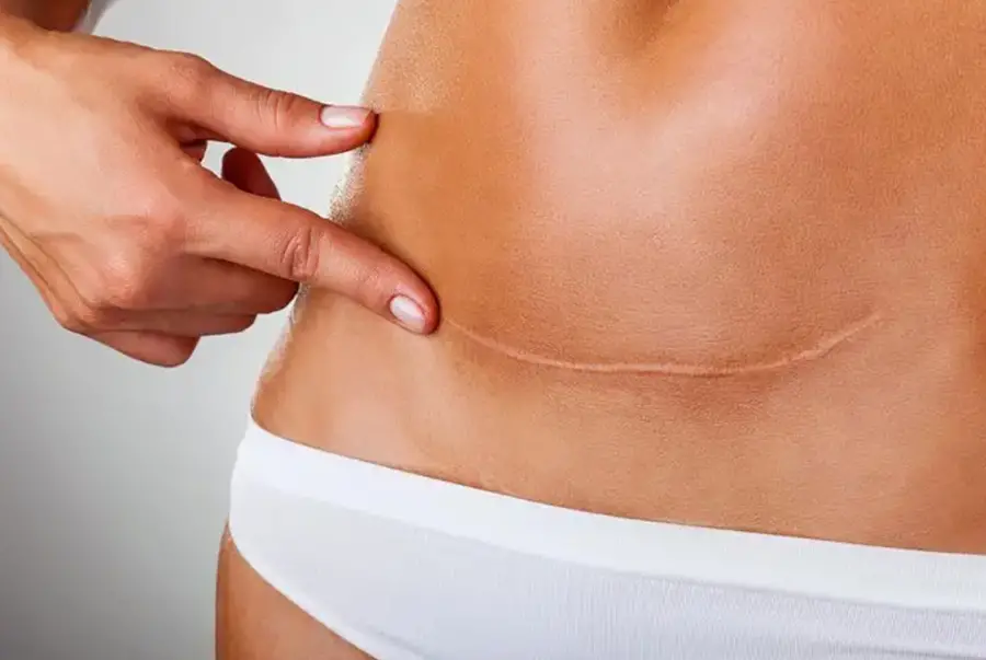 DOĞUM DİKİŞ İZLERİ ESTETİĞİ-EPİZYOTOMİ İZLERİNİN DÜZELTİLMESİ
