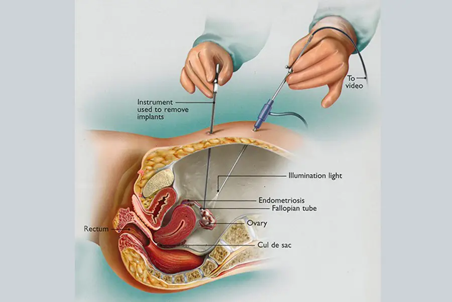 ENDOMETRİOZİS CERRAHİSİ